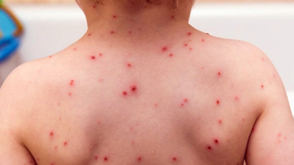 Sarampión: Alarma por el aumento de los casos en el país